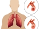 Bronchitis Bronchialkatarrh Atemwegentzundung