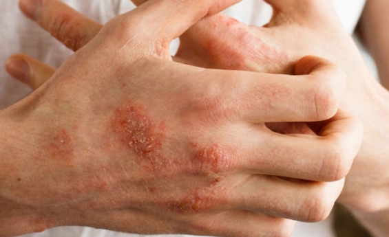 Allergien lindern mit Heilmitteln aus der Kloosterheilkunde