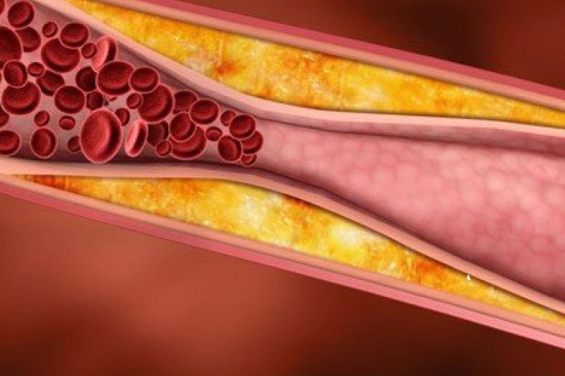 Arteriosklerose – Klosterheilkunde zur Unterstützung der Gesundheit