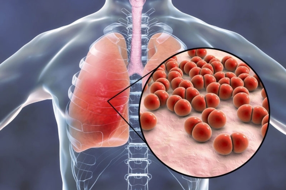 Bronchitis heilen: Teemischungen aus Heilkräutern für schnelle Linderung