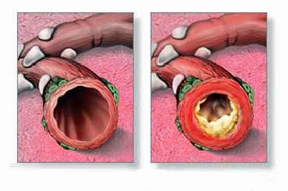 Bronchitis heilen: Speisen, Bäder, Massagen und Umschläge – Natürliche Heilmittel