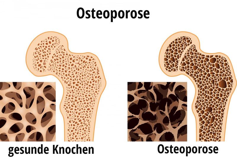 Osteoporose