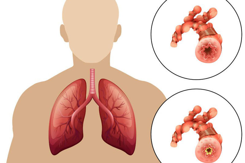 Bronchitis