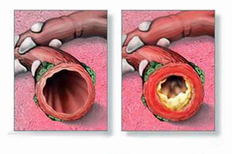 Bronchitis