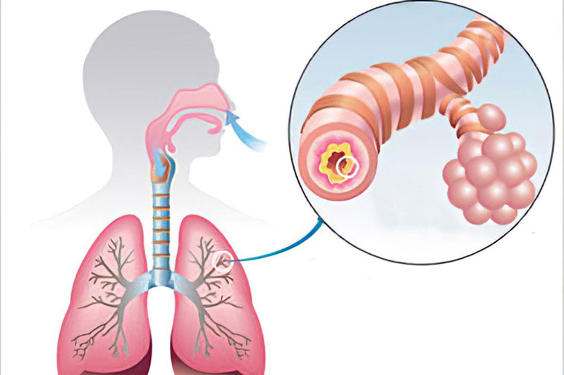 Bronchitis